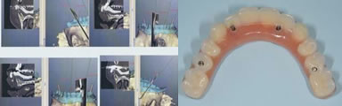 手術シミュレーションソフト、仮歯