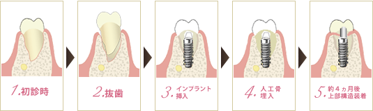 抜歯即時インプラントフロー図