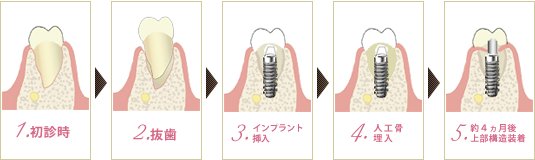 抜歯即時インプラントフロー図