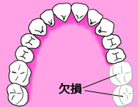 歯の欠損