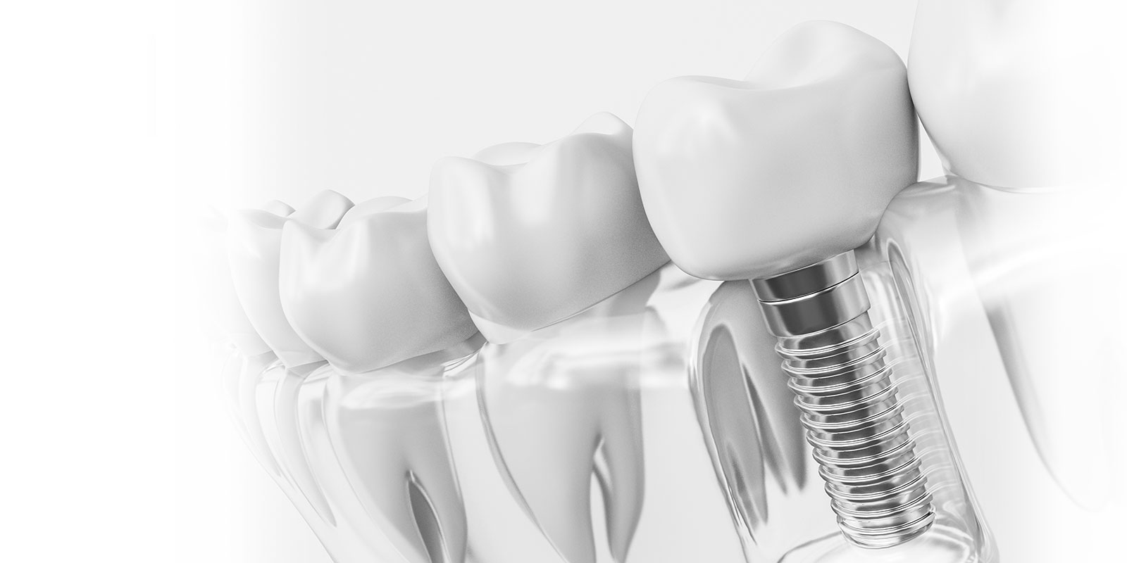 インプラントと自分の歯との違いとは？