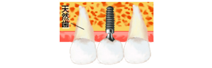骨の厚みが足りない上の奥歯に1本、見た目を重視して埋入した例