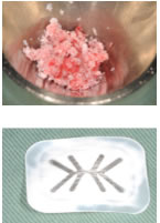GBR(骨組織再生法)