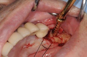 24,25インプラント症例集_r3_c1