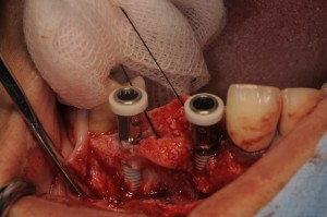 前歯部のスプラインインプラント埋入とGBR