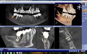 抜歯早期のスプラインHAインプラント埋入